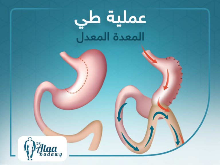 عمليات طي المعدة المعدل
