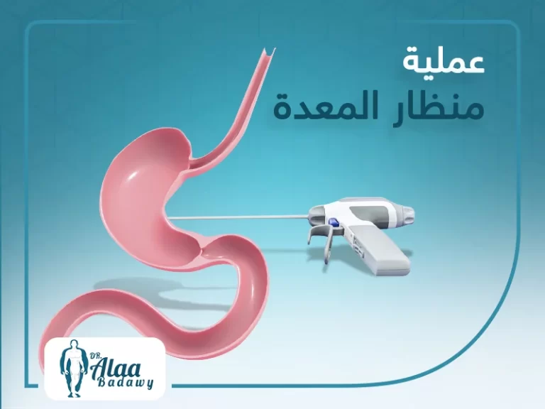 عملية منظار المعدة